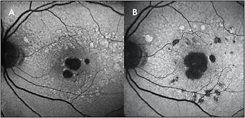 Figure 1. Fundus autofluorescence images of a patient with geographic atrophy demonstrating clear progression of the lesions. Figures A and B were taken approximately 4 years apart.