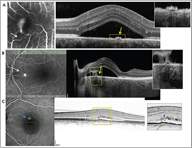 Figure 1. Acute central serous chorioretinopathy (CSCR) with a smokestack leaky RPE break on FA (white arrow) and a bullous detachment of the macula. Note the focal RPE detachment on SD-OCT corresponding to the leaky point (yellow arrow and magnification) (A). Acute CSCR with a leaky RPE break temporal to the optic nerve on FA (white arrow), leading to a temporal juxtafoveal serous detachment. Note the RPE detachment at the leaky point (yellow arrow and magnification) with hyper-reflective vertical tracks, potentially corresponding to proteins suspended in the subretinal fluid (B). Low-intensity leaky point (white arrow) corresponding to a subtle RPE bump (yellow arrow and magnification), over pachyvessel (orange arrow) and with hyperfelective dots in the subretinal fluid and the outer retina (C).