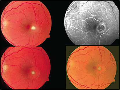Figure 5. A fungal macular infiltrate spreading from the choroid into the retina. Fluorescein angiography demonstrates the inward spread of the lesion from the choroid into the retina with displacement of retinal tissue and vessels as the lesion invades the inner retinal layers (and vitreous). The healed lesion leaves a residual pigmented ring. FIGURE REPRINTED WITH PERMISSION FROM ELSEVIER.1