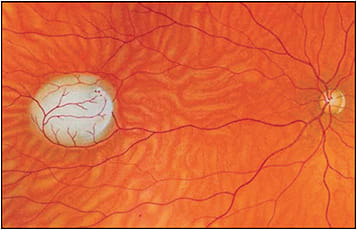 Figure 1. Fundus drawing of (likely) what is now known as retinoblastoma from an English translation of Atlas und Grundiss der Ophthalmoscopie und Opthalmoscopischen Diagnostik by Otto Haab, originally published in 1895.