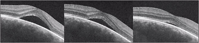 Figure 1. Resolution of exudative foveal detachment in a patient with CSC over a period of several months (left to right). Note the preservation of the two posterior retinal layers, the external limiting membrane and ellipsoid zone, indicative of preservation of the photoreceptors.