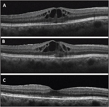 Figure 1. A 63-year-old female developed CME in the right eye 1 month after scleral buckle and vitrectomy with 16% perfluoropropane (C3F8) for macula-sparing retinal detachment (A). She had persistent CME after 6 weeks of treatment with topical steroids and NSAIDs (B). However, 6 weeks after intravitreal injection of triamcinolone acetonide, there was resolution of CME (C).
IMAGE COURTESY OF AJAY E. KURIYAN, MD, MS.