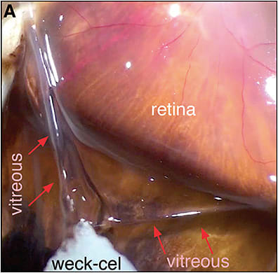 Figure 1. Peripapillary and macular surface membranes remain following posterior vitreous detachment.