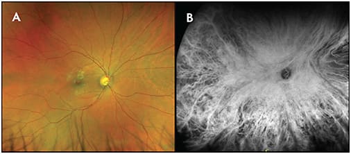 Figure 5. Widefield indocyanine green angiography. Unremarkable fundus appearance (A). Widefield ICG revealed diffuse hypercyanescence indicative of subtle diffuse choroidal hemangioma.