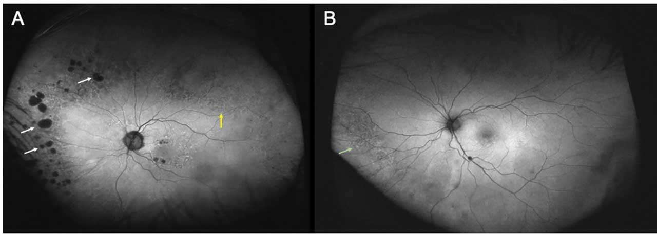 Figure 3. Autofluorescence changes in AMD, including nummular FAF changes (examples delineated with white arrowheads), granular FAF changes (yellow arrowhead) (A) and mottled FAF changes (green arrowhead) (B).