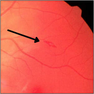 Figure 2. Magnified view of white-centered hemorrhage.