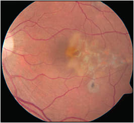 Figure 4. Serpiginous-like choroiditis with a positive interferon gamma release assay test. There is evidence of an active border of choroiditis superiorly and inferiorly. FIGURE REPRINTED WITH PERMISSION FROM ELSEVIER.1