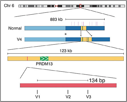 Figure 4. Chromosome 6 ideogram showing the 883 kilobase region on which I performed targeted sequencing. Within that region, there is a 123-kilobase duplication, which is variant 4 (V4) in our Belizean family, which was ascertained with the help of Dr. Maurice Rabb. The more common mutations, variants V1, V2, and V3, are point mutations in the DNASE 1 hypersensitivity binding site thousands of base pairs upstream in a noncoding region. V1 is the mutation present in most American families with NCMD. Image originally published in Small et al.5