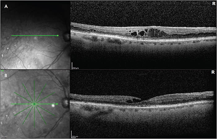 Figure 1. A 71-year-old male with persistent diabetic macular edema (DME). Optical coherence tomography was taken after 6 intravitreal aflibercept injections (A) and visual acuity was 20/50. There was improved central DME after 2 intravitreal faricimab injections (B), in addition to development of a small nonsignificant lamellar hole. Visual acuity improved to 20/30.