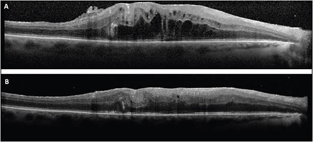 Figure 3. A 65-year-old male developed CME in the right eye after scleral buckle and vitrectomy with 16% perfluoropropane (C3F8). Exam also revealed an epiretinal membrane (ERM) (A). The CME improved after ERM peel and treatment with topical steroids and NSAIDs (B).
IMAGE COURTESY OF JAYANTH SRIDHAR, MD.