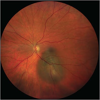 Figure 2. Clarus (Zeiss) widefield photograph of a choroidal melanoma. Field of view is wider than traditional fundus photography but does not capture as much of the periphery as ultrawidefield photographs. Note the accurate coloration of the retina.