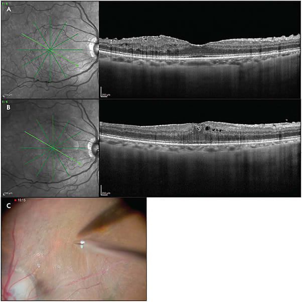 Figure 2. An eye without sukima. Optical coherence tomography (OCT; Heidelberg Spectralis) showed that there was no separated space between the epiretinal membrane and the inner limiting membrane preoperatively (A). Visual acuity was 20/30. Postoperative OCT revealed that the retinal thickness did not change without significant improvement of the disruption of ellipsoid zone and inner nuclear layer (B). Visual acuity remained 20/30. An intraoperative picture