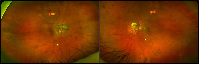 Figure 3. Roth spots in a patient with myelofibrosis. Photo courtesy of Timothy Fuller, MD