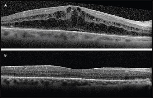 Figure 2. A 72-year-old female developed CME in the right eye 1 month after vitrectomy with 14% perfluoropropane (C3F8) for macula-involving retinal detachment with early proliferative vitreoretinopathy (A). The CME resolved 2 months after treatment with topical steroids and NSAIDs and intravitreal injection of sustained release 0.7 mg dexamethasone (B).
IMAGE COURTESY OF JAYANTH SRIDHAR, MD.