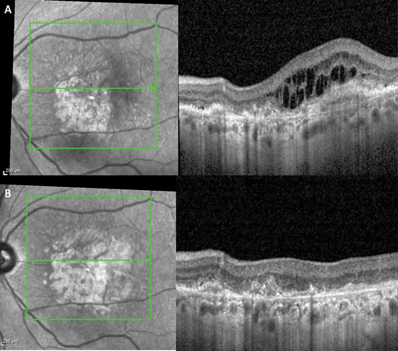 Figure 2.  Vision in a patient with exudative age-related macular degeneration (A) remains limited despite fluid resolution due to geographic atrophy and fibrosis (B) in the same eye.