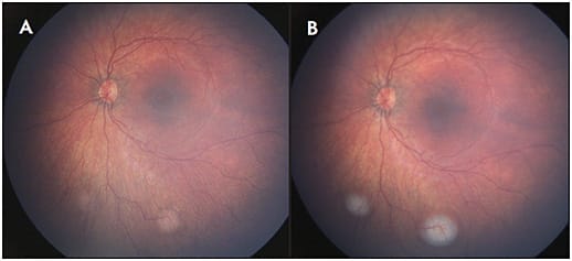 Figure 2. Widefield fundus photography. Two small extramacular retinoblastoma tumors documented with Retcam (A). Appearance immediately after treatment with transpupillary thermotherapy (B).