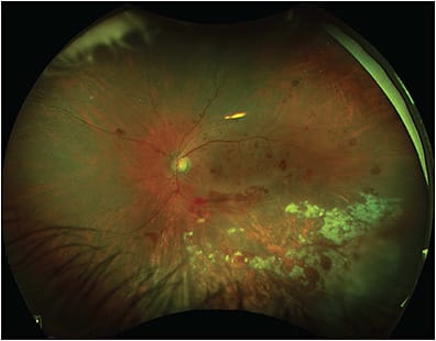 Figure 6. Optos ultrawidefield color fundus photograph of active cytomegalovirus retinitis.