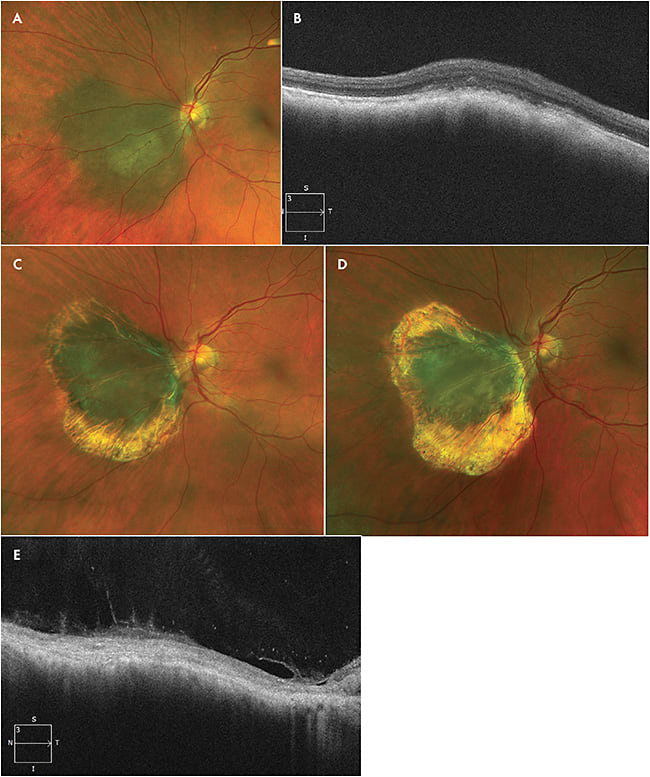 Figure 1. A 65-year-old male with long-standing history of choroidal nevus that was documented to have enlarged on a recent examination. The patient had diabetes mellitus without ocular manifestations. Visual acuity was 20/20 in the left eye with normal intraocular pressures. A juxtapapillary melanocytic choroidal mass inferonasal to the disc between the 7-o’clock and 9-o’clock positions that measured approximately 7.5 mm x 6.0 mm x 1.5 mm was observed (A). Presence of subretinal fluid at the apex and orange pigmentation were documented. Optical coherence tomography shows disruption of the outer retina (B). Given the patient’s history of diabetes mellitus and juxtapapillary location and fundus autofluorescence, the patient received transpupillary thermotherapy as primary therapy rather than episcleral brachytherapy. Transpupillary thermotherapy was performed under sedation and retrobulbar anesthesia, through the dilated pupil, using indirect diode laser (spot size 2 mm). In total, 30 spots of 1 minute each duration were applied to the tumor surface and 1 mm adjacent choroid with a power of 120 mW. There was good uptake. Three such sessions at 3-month intervals were performed without complications. Tumor atrophy was noted at the end of therapy (C), which continued to progress without additional therapy over the next 12 months (D). Note that the retina is replaced by a layer of gliotic tissue (E).