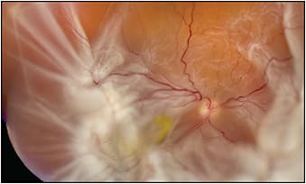 Figure 2. Here is a longstanding rhegmatogenous retinal detachment with pre-funnel configuration and extensive PVR with macular dragging (macula lutea yellow color). Retinal reattachment was accomplished with scleral buckle, retinectomy, and silicone oil tamponade.