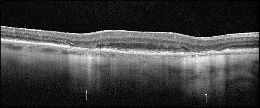 Figure 1. Optical coherence tomography scan of a patient with geographic atrophy showing 2 paracentral areas of choroidal hypertransmission &gt;250 µm in diameter corresponding to extrafoveal geographic atrophy.