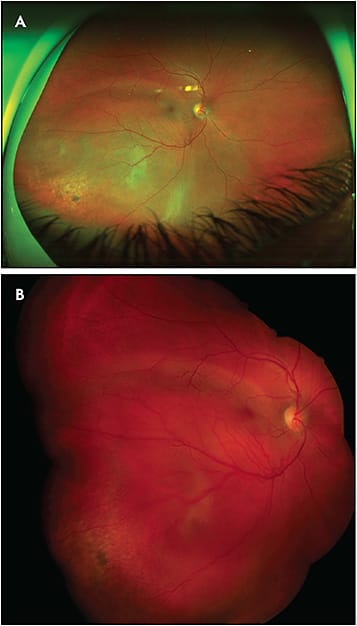 Figure 4. A large circumscribed choroidal hemangioma. The Optos ultrawidefield image (A) shows the majority of the tumor borders but produces a potentially misleading false color. The standard fundus camera (B) is able to create a montaged image which has a narrower field but shows the characteristic true (red) color of this lesion.