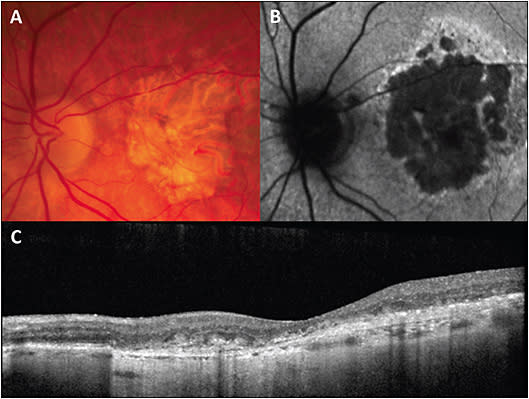 Figure 1. Color fundus photograph shows geographic atrophy with well-demarcated borders and depigmentation, as compared to the surrounding fundus, with increased visibility of the choroidal vessels (A)