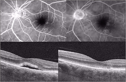 Figure 5. Photodynamic therapy of CSC. Fluorescein angiography (early frame, top left, late frame top right, showing pinpoint RPE leaks in temporal macular region of the left eye) and pre- (bottom left) and post-PDT (bottom right) OCT images showing resolution of foveal detachment in a patient with CSC treated with half-fluence PDT in the area of pinpoint RPE leaks.