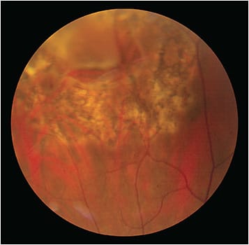 Figure 3. Laser retinopexy scars around a retinal tear. Pigmentation begins to form about 4 days after retinopexy. This photo was taken 1 month after laser application.