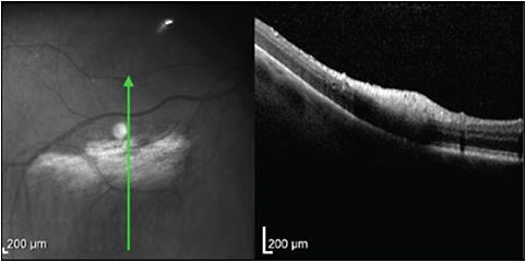 Figure 9. Myelinated nerve fiber layer. Optical coherence tomography (Zeiss Cirrus HD-OCT model 5000) demonstrates focal hyperreflectivity with subtle thickening of the nerve fiber layer in the area of retinal whitening.