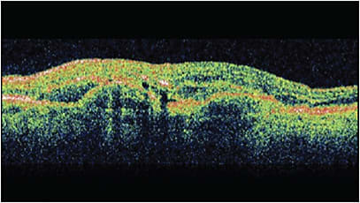 Figure 2. Optical coherence tomography of a left eye with multiple pigment epithelial detachments and significant subretinal fluid.