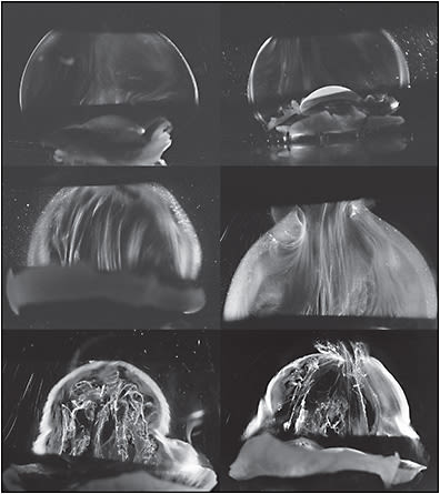 Figure 3. Aging changes in human vitreous structure. Dark-field slit microscopy of fresh unfixed whole human vitreous with the sclera, choroid, and retina dissected off the vitreous body, which remains attached to the anterior segment. A slit lamp beam illuminates from the side, creating a horizontal optical section with an illumination-observation angle of 90 degrees, maximizing the Tyndall effect. The anterior segment is below, and the posterior pole is above in all specimens.