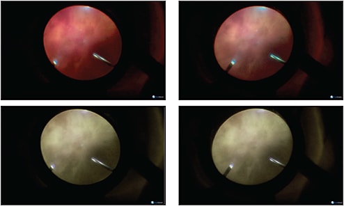 Figure 4. These cross-fusable images were recorded 100 ms apart with normal color settings (top) and with digital redshift settings (bottom). Note the vitreous hemorrhage is less prominent, resulting in better visualization of the retinal surface with the redshift setting, and the cone of light from the light pipe is more evident with the color imaging.