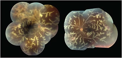 Figure 8. Cytomegalovirus-related frosted branch angiitis. This patient also had untreated HIV with a very high viral load. FIGURE REPRINTED WITH PERMISSION FROM ELSEVIER.1