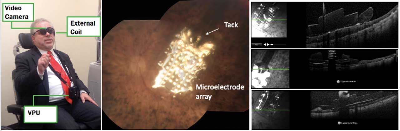 Figure 2. An Argus II epiretinal device (Second Sight Medical Products). Left: external components of the Argus II (video camera, video processor unit, and external coil). Center: fundus picture of the left eye demonstrating a 6 mm x 10 mm electrode array over the macula. A tack is used to fix the array to the retina. Right: optical coherence tomography of the electrode array and tack over the atrophic retina. A patient of corresponding author Sandra R. Montezuma, MD, agreed to publication of these images.