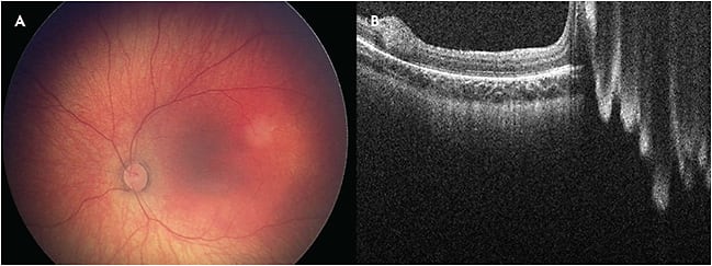 Figure 1. Fundus image of tiny retinoblastoma that was not identifiable with ophthalmoscopy (A) and corresponding OCT image (B). The tumor that was detected by ultrasound biomicroscopy is outside the arcades (not the existing tumor next to the fovea).