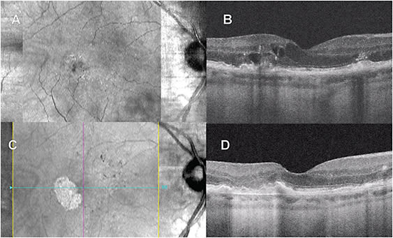 Figure 1. Development of macular atrophy after serial anti-VEGF treatment of wet AMD. Clinical photo (A) and optical coherence tomography (B) on presentation showed cystoid macular edema associated with a retinal angiomatous proliferation lesion (type 3 macular neovascularization). Clinical photo (C) and optical coherence tomography (D) after 2 years of serial anti-VEGF administration, showing the resolution of edema and occurrence of extrafoveal macular atrophy in the region of the previously leaking retinal angiomatous proliferation lesion (temporal macula).