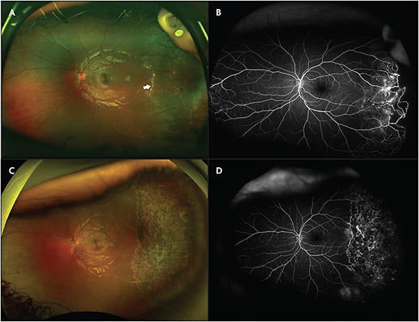 Figure 1. Stage 2A Coats disease. A patient presented with classic extrafoveal exudation (white arrow), dilated vessels, telangiectasias, and aneurysms (A). Fluorescein angiogram demonstrated aneurysms, telangiectasias, and early neovascularization with anterior avascular retina (B). Further, nasal telangiectasias were noted that were difficult to identify on exam. After photocoagulation, resolution of the exudation can be noted (C, D).