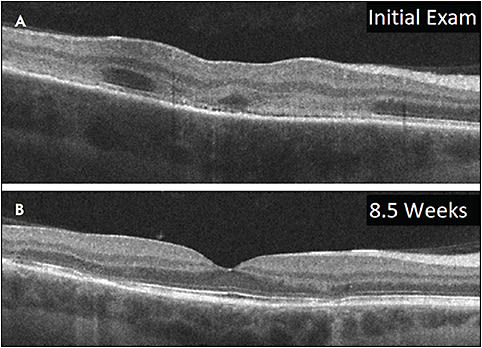 Figure 8. Acute posterior multifocal placoid pigment epitheliopathy. Upon initial presentation, there are discrete lesions of hyperreflectivity from the OPL to RPE and corresponding loss of identifiable external limiting membrane and ellipsoid zone layers (A)