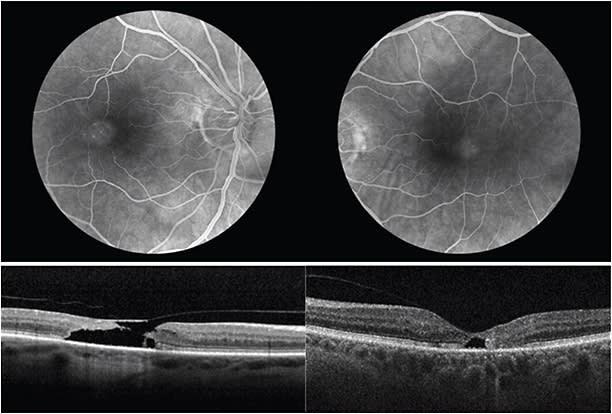 Figure 1. Classic examples of FA and SD-OCT retinal imaging in patients with MacTel type 2. In this patient, the extensive cavitation in the right eye has progressed to a full-thickness macular hole, with a newly released ILM drape. The left eye shows classic cavitation present as well, but to a lesser extent.