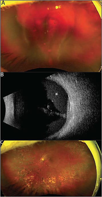 Figure 1. Diabetic vitreous hemorrhage. Widefield fundus photograph on presentation with counting fingers 2-foot vision (A). B scan ultrasound demonstrated retinal attachment with significant subhyaloid hemorrhage (B, asterisk). Widefield fundus photograph 2 months following vitrectomy with clear media and mixture of old and new panretinal photocoagulation (C). Vision improved to 20/60, the preoperative baseline.