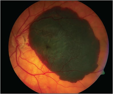 Figure 1. A traditional fundus photograph of subretinal hemorrhage in the macula.
