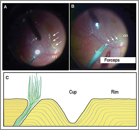 Figure 2. Schematic of optic pit vitreous strands removed during surgery. After abrasion using the Tano diamond-dusted membrane scraper (Bausch + Lomb), vitreous strands penetrating into the optic pit were visible with triamcinolone staining and were removed with forceps.