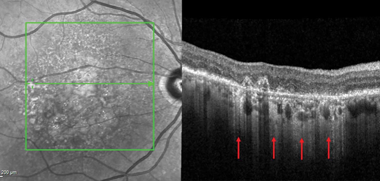 Figure 1.  Optical coherence tomography demonstrating geographic atrophy with foveal blunting in advanced macular degeneration. Significant hypertransmission (red arrows) show the extent of atrophy.