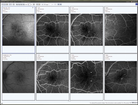 Figure 1. A series of images from fluorescein angiography can be compared side-by-side in a PACS format.