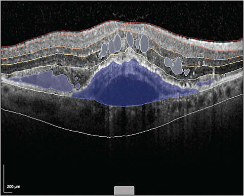 Fluid and layer segmentation using the Discovery Core platform from RetinAI.