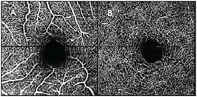 Figure 2. Motion artifact shown on the OCTA superficial vascular complex (A) and deep vascular complex (B), toward the center of the image, where the abrupt discontinuity is shown by the black lines disrupting the otherwise sharp vasculature nearby.