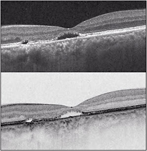 Figure 2. Chronic CSC (top, grayscale, bottom, reverse grayscale). Note pachychoroid (350 microns in this case) and foveal thinning (100 microns in this case) associated with a disrupted ellipsoid zone. The photoreceptor outer segments are elongated and elevated over the RPE in the area of foveal neurosensory retinal detachment.