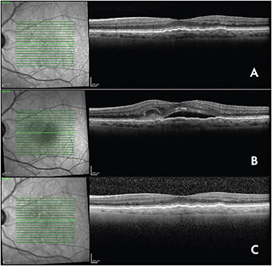 Figure 3. Example of progression on optical coherence tomography from (A) baseline to (B) detection at Foreseehome alert to (C) post-treatment appearance in first eye of patient with conversion to nAMD. Image courtesy Byron Ladd, MD