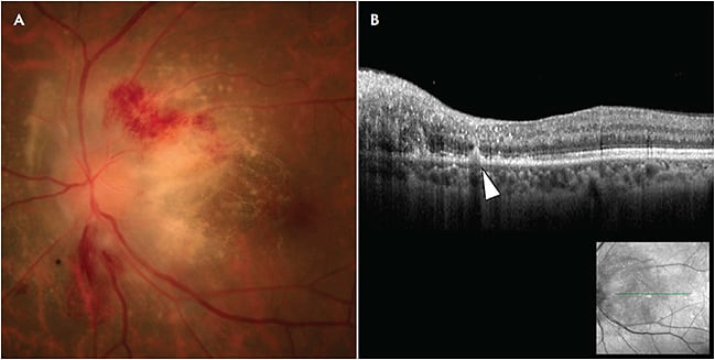 Figure 1. Fundus photograph of the left eye of a 47-year-old male with floaters and blurry vision. Examination reviewed vitreous cells and a creamy subretinal infiltrate predominantly involving the optic nerve (A). Optical coherence tomography showed a hyper-reflective (arrow) subretinal pigment epithelium infiltrate (B). The findings could be consistent with infectious retinitis; however, in this case, the patient had a known history of diffuse large B-cell lymphoma.