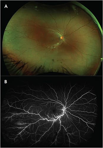 Figure 4. Optos ultrawidefield fundus photograph (A) and fluorescein angiography (B) of branch retinal vein occlusion.